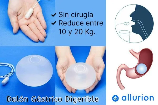 Balon gastrico digerible allurion