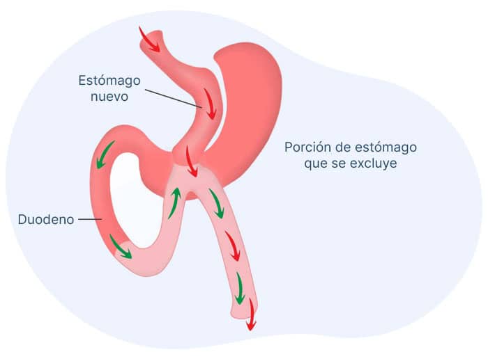 Bypass una sola anastomosis