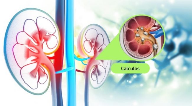 Tratamiento para Cálculos Renales