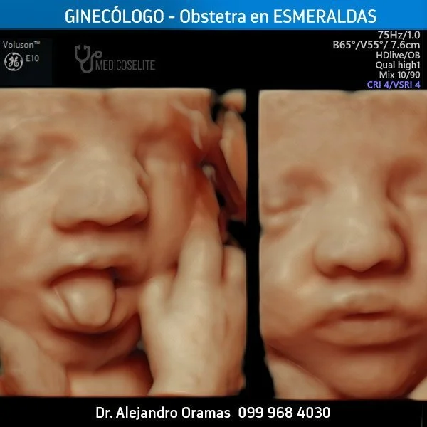 Ecografia3d esmeraldas dr oramas ginecologo