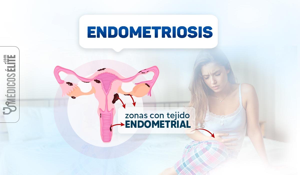Endometriosis Síntomas Diagnóstico Y Tratamiento