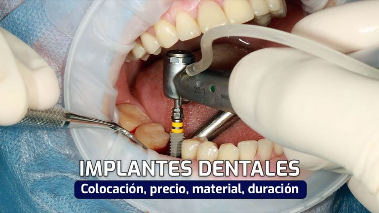implantes-dentales-colocacion-precio-duracion