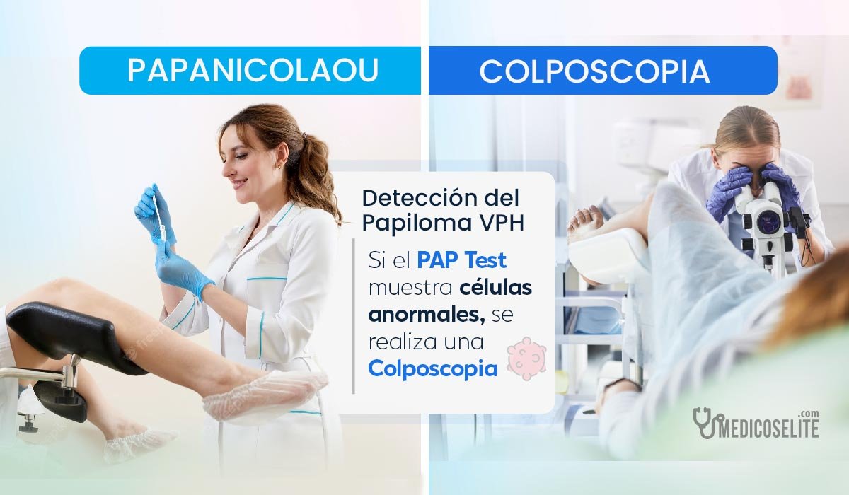 Papanicolaou Y Colposcopia Para Detectar Papiloma Humano