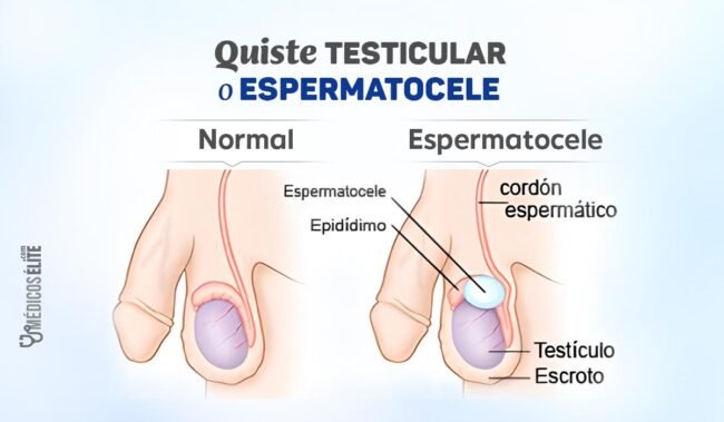 Quiste testicular o Espermatocele