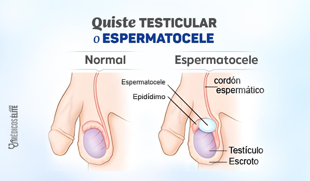 Quiste Testicular O Espermatocele