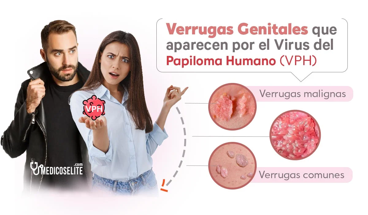 Verrugas Genitales Causadas Por El Papiloma Humano Cepas 6 Y 11