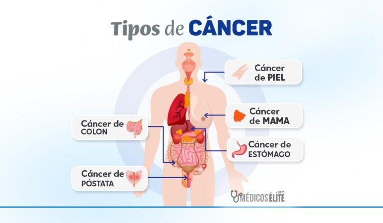 Tipos de cáncer más comunes