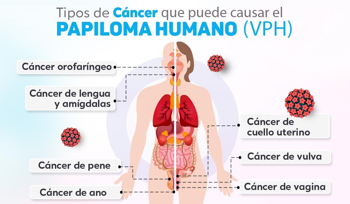 Tipos De Cáncer Causados Por El Virus Del Papiloma Humano Vph