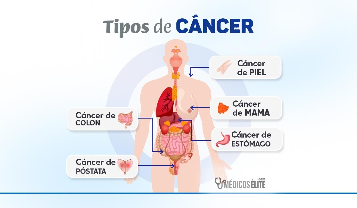 Oncología Y Tipos De CáncermédicosÉlite